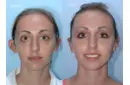 Kulak Küçültme Nedir ve Nasıl Yapılır?